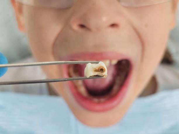 Best Knocked-Out Tooth (Avulsed Tooth) Treatment in Boiling Springs, SC